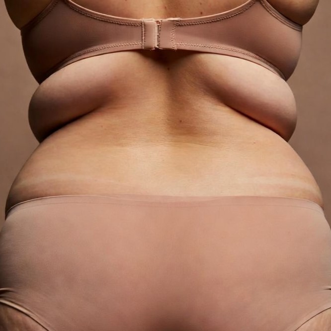 Liposuccion 360 / BBL - Avant Liposuccion 360 / BBL - Avant